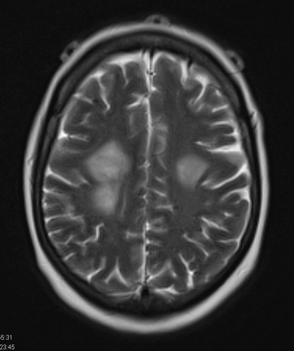 21A2 Lymphoma (Case 21) T2 W 1 - Copy