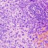 21B Lymphoma (Case 21) H&E 1