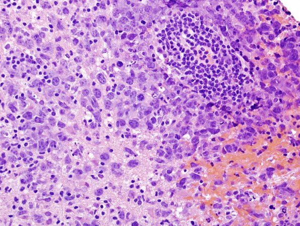 21B Lymphoma (Case 21) H&E 1