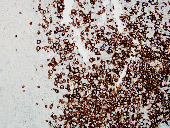 21C1 Lymphoma (Case 21) CD20 20X