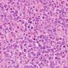 22A2 Lymphoma, B cell type (Case 22) H&E 6.jpg