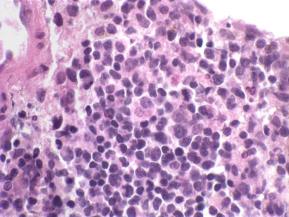 23A Lymphoma (Case 23) H&E 3