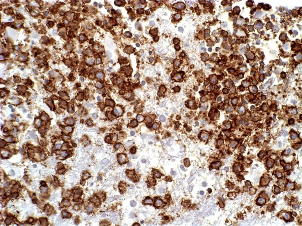 23B Lymphoma (Case 23) CD20 (L26) b