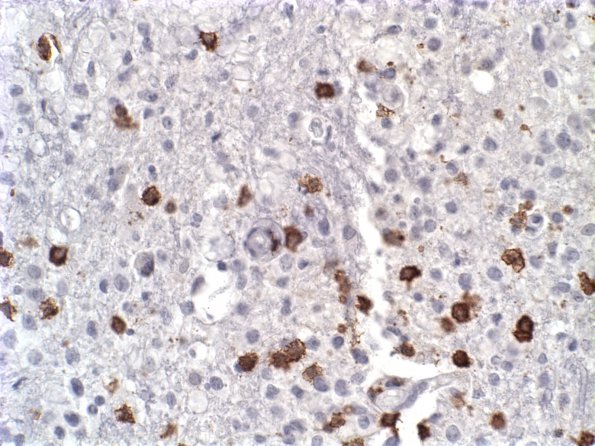 23C Lymphoma (Case 23) CD3 a