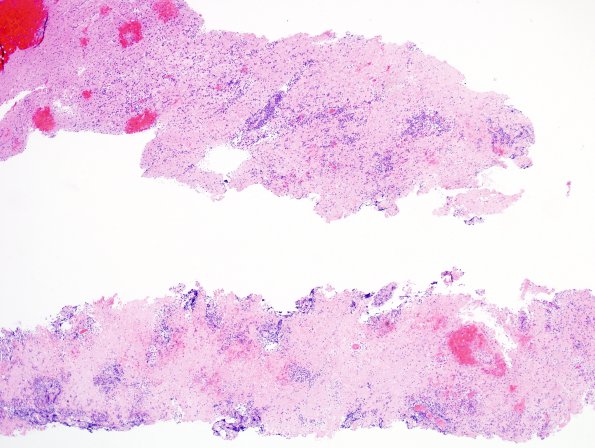 24A1 Lymphoma (Case 24) H&E 1