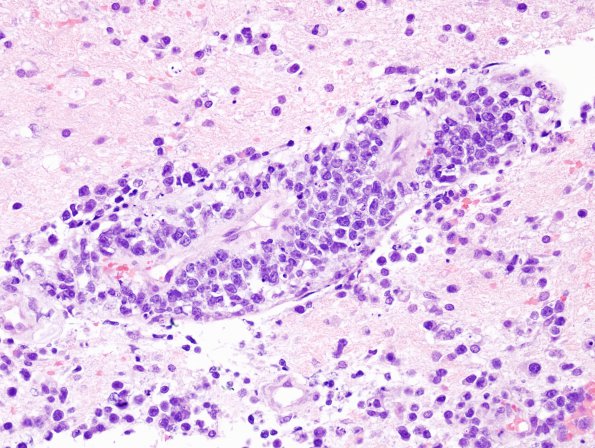 24A2 Lymphoma (Case 24) H&E 3