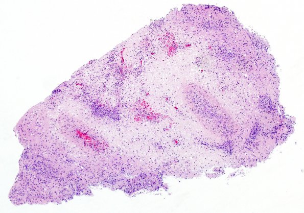 25A Lymphoma (Case 25) H&E 4X