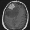 26A Lymphoma (Case 26) T1 W - Copy