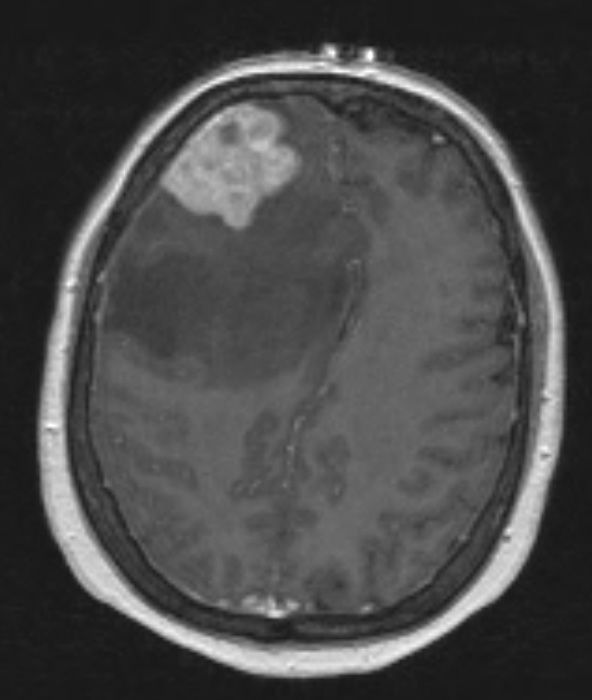 26A Lymphoma (Case 26) T1 W - Copy