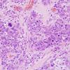 26B2 Lymphoma (Case 26) H&E 4