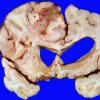 27A2 Lymphoma (Case 27) gross 2