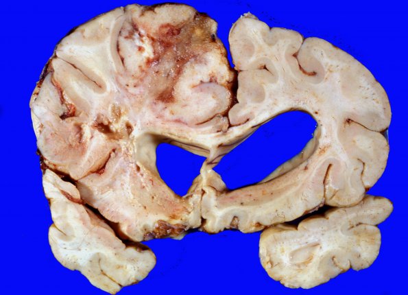 27A2 Lymphoma (Case 27) gross 2