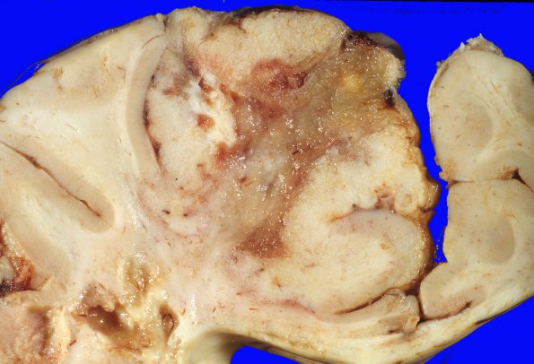 27A3 Lymphoma (Case 27) 1