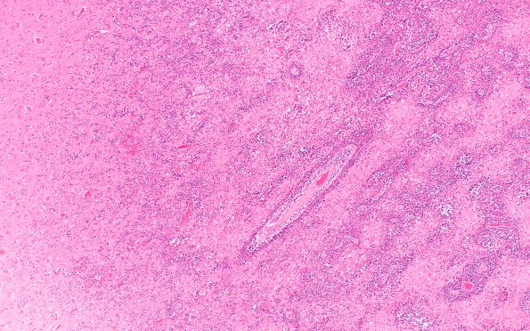 27B Lymphoma (Case 27) H&E 7