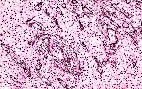 27C Lymphoma (Case 27) Retic