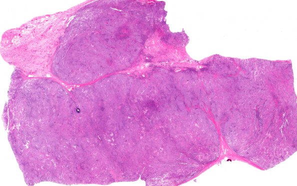 28A1 Lymphoma, B-cell, spindle-sclerosing variant (AANP 2016-Case 4)