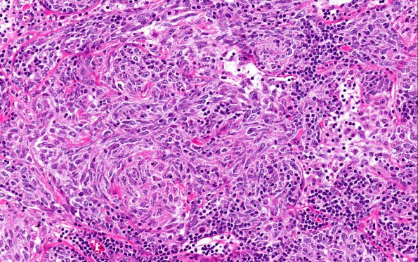 28A2 Lymphoma, B-cell, spindle-sclerosing variant (AANP 2016-Case 4) 20X 2