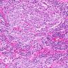 28A3 Lymphoma, B-cell, spindle-sclerosing variant (AANP 2016-Case 4) 20X