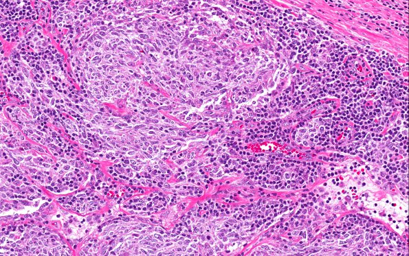 28A3 Lymphoma, B-cell, spindle-sclerosing variant (AANP 2016-Case 4) 20X