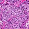 28A4 Lymphoma, B-cell, spindle-sclerosing variant (AANP 2016-Case 4) 40X 2