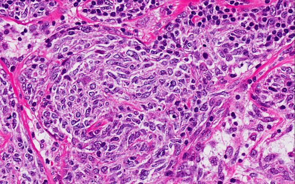 28A4 Lymphoma, B-cell, spindle-sclerosing variant (AANP 2016-Case 4) 40X 2