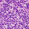 2B2 Lymphoma, B cell type (Case 2) H&E 100X 1.jpg