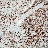 2D Lymphoma, B cell type (Case 2) CD3 1.jpg
