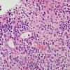 3B Lymphoma (Case 3) H&E 2