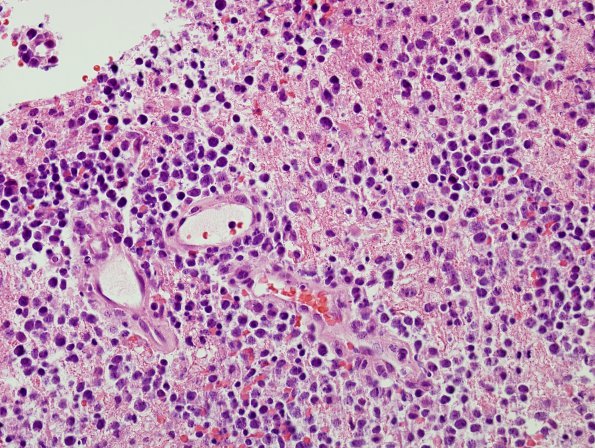 3B Lymphoma (Case 3) H&E 2