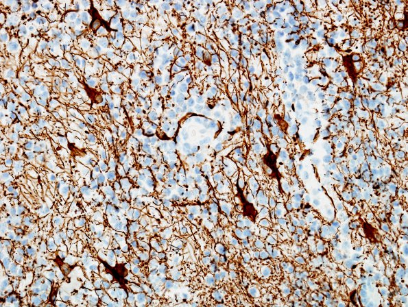 3E Lymphoma (Case 3) GFAP 2