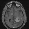 4A Lymphoma (Case 4) T1 - Copy - Copy