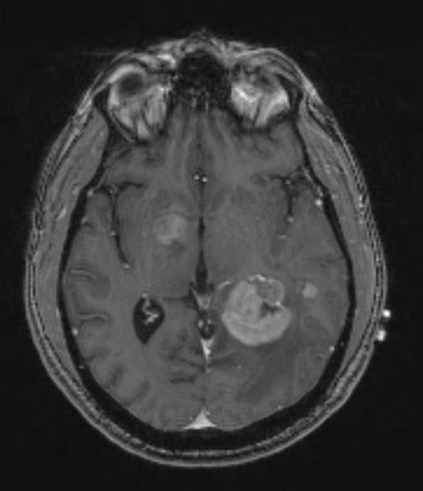 4A Lymphoma (Case 4) T1 - Copy - Copy