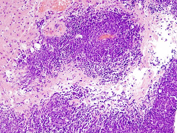 4B Lymphoma (Case 4) H&E 2