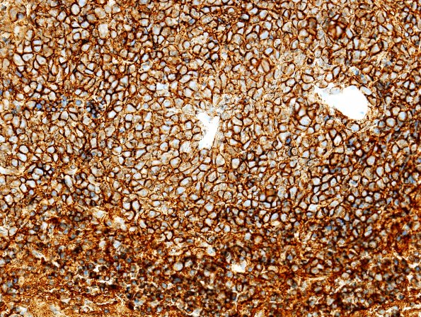 4C1 Lymphoma (Case 4) CD20