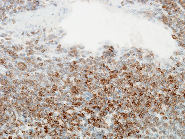 4C2 Lymphoma (Case 4) BCl-2