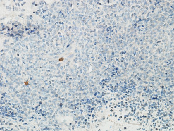 4C3 Lymphoma (Case 4) CD3