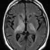 5A1 Lymphoma (Case 5) FLAIR 2 - Copy