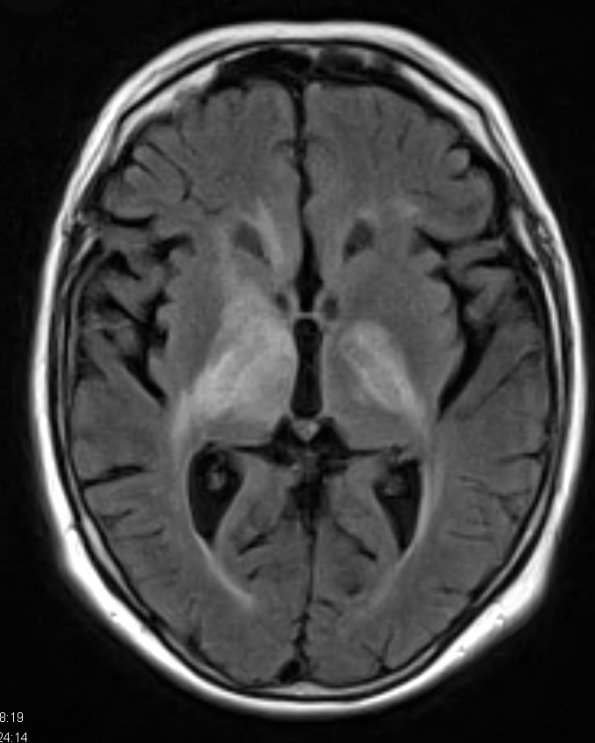 5A1 Lymphoma (Case 5) FLAIR 2 - Copy