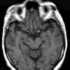 5A2 Lymphoma (Case 5) T1 - Copy