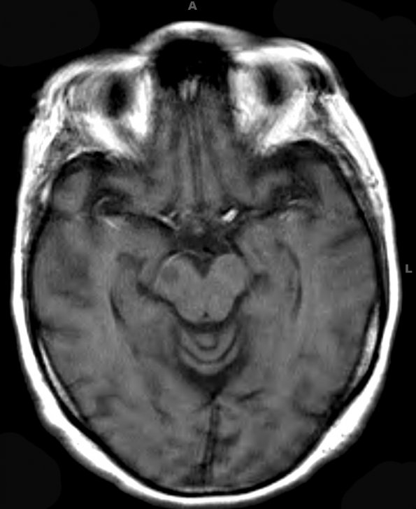 5A2 Lymphoma (Case 5) T1 - Copy