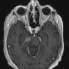 5A3 Lymphoma (Case 5) T1 W 1 - Copy