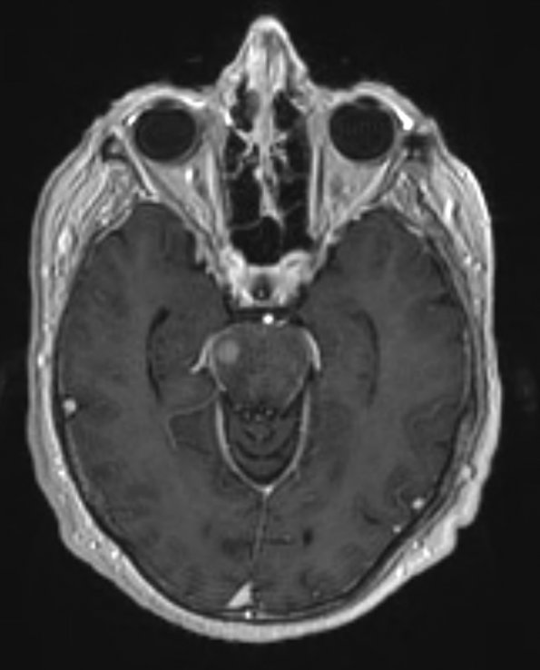 5A3 Lymphoma (Case 5) T1 W 1 - Copy