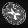 5A4 Lymphoma (Case 5) T2 3 - Copy