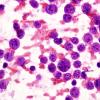 5B1 Lymphoma (Case 5) Smear 3