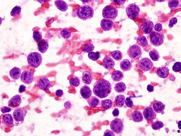 5B1 Lymphoma (Case 5) Smear 3