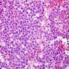 5B3 Lymphoma (Case 5) H&E 1