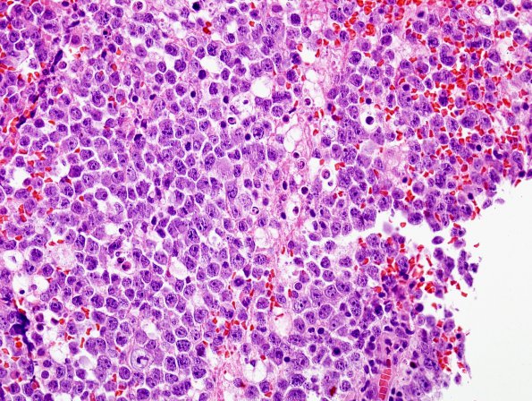 5B3 Lymphoma (Case 5) H&E 1