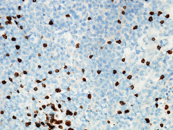 5D Lymphoma (Case 5) CD 3