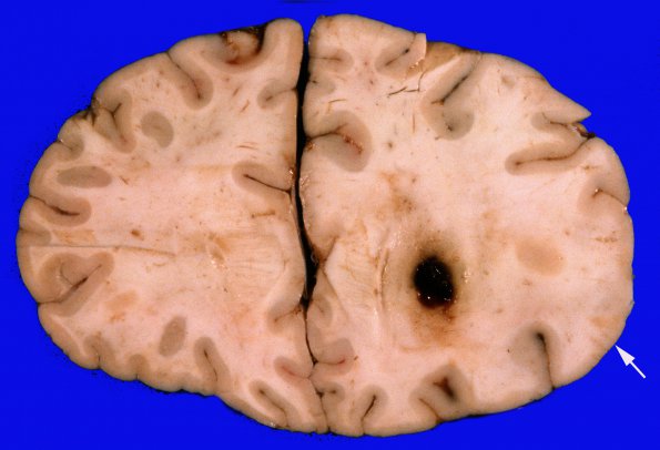 6A2 Lymphoma (Case 6) copy