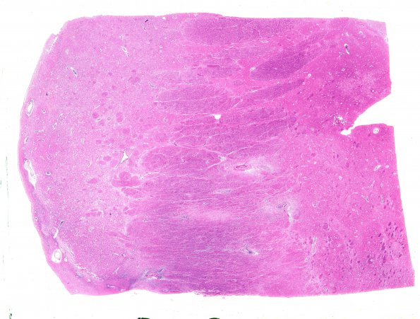 6B1 Lymphoma (Case 6) N4 H&E WM